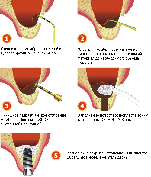Синус- лифтинг